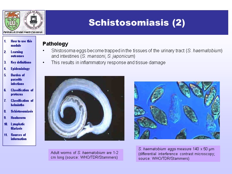 Schistosomiasis (2) Pathology Shistosoma eggs become trapped in the tissues of the urinary tract